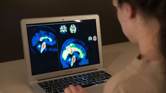 Investigadores europeos mejoran la sensibilidad del diagnóstico de las fases iniciales del Alzheimer