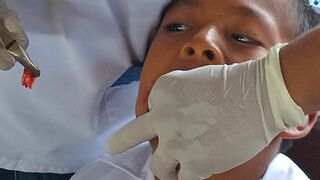 Extracción en campaña médica en Porvenir