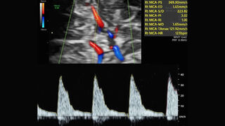 Ensayo clínico RATIO37