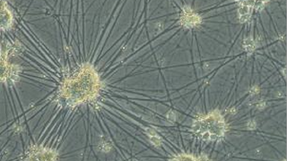 La Caixa impulsa la investigación sobre esta enfermedad