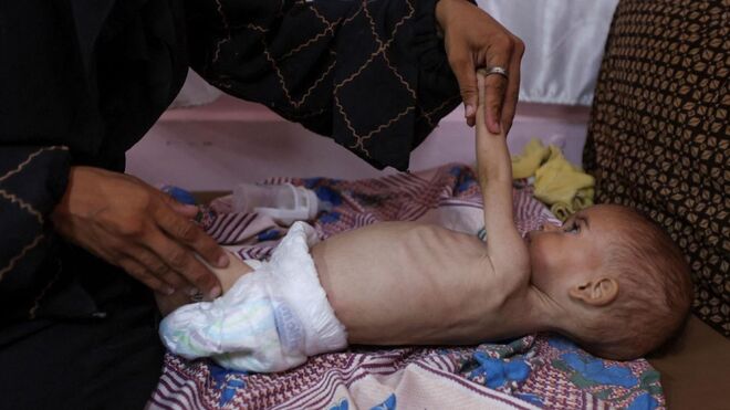 Niña palestina desnutrida recibe tratamiento en el Hospital Nasser de Khan Younis, en el sur de la Franja de Gaza
