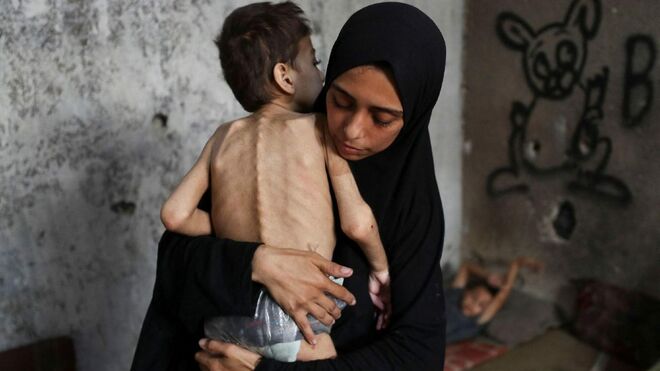 Una madre abraza a su hijo desnutrido (MAHMOUD ISSA)